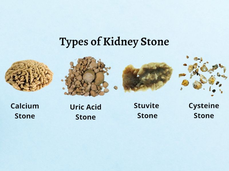 8-facts-about-kidney-stones-that-you