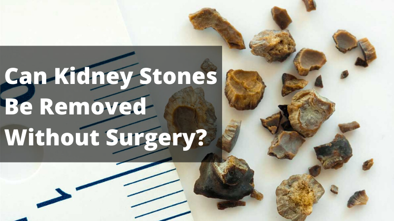 Kidney Stones Be Removed Without Surgery in Bangalore