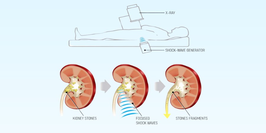 Penile Cancer